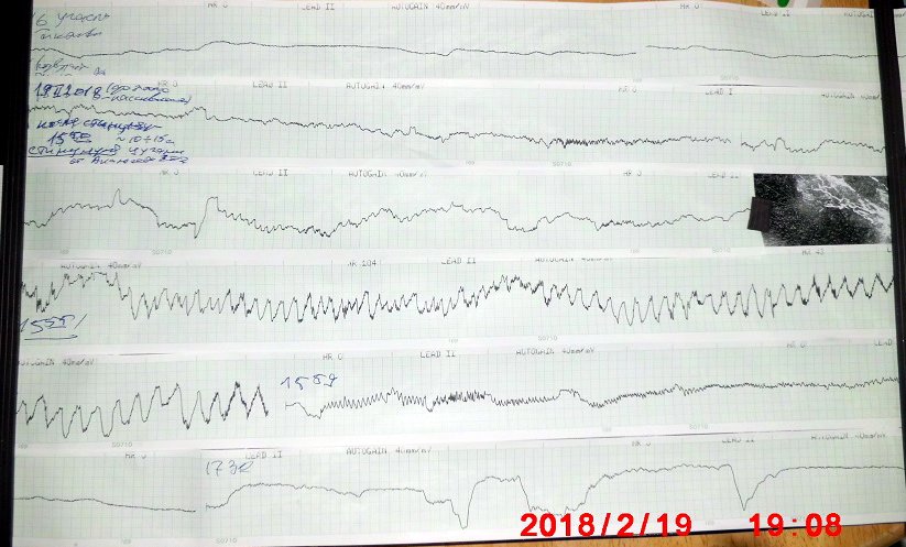 REM StimCIMG11331
